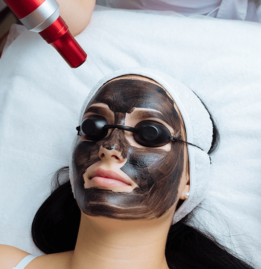 Carbon Laser Facials
