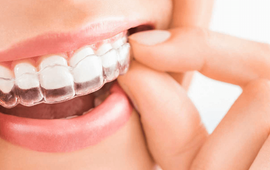 Aligners(Invisible Braces)