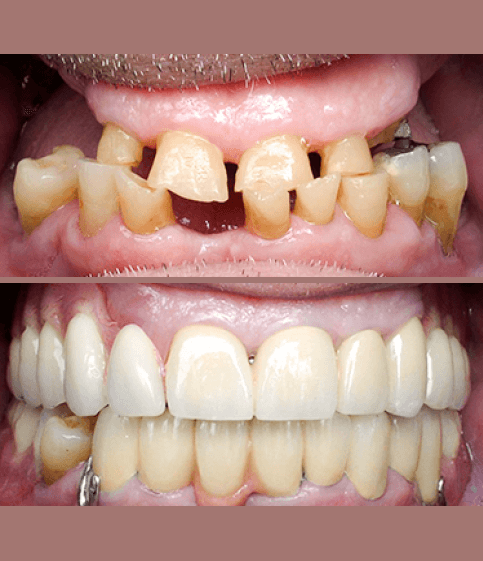 Full Mouth Rehabilitation