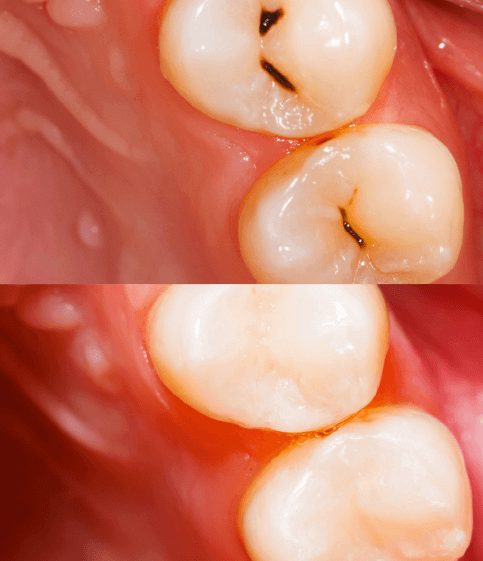 Dental Cavities