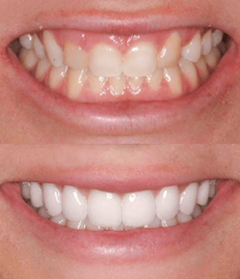 Smile Design Treatment