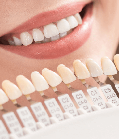 Dental Veneers