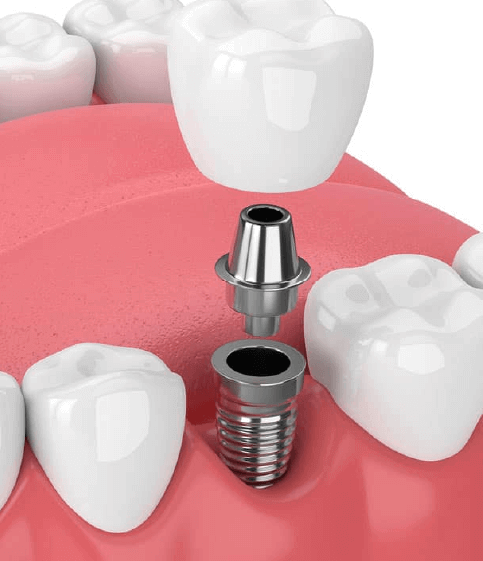 Dental Implants