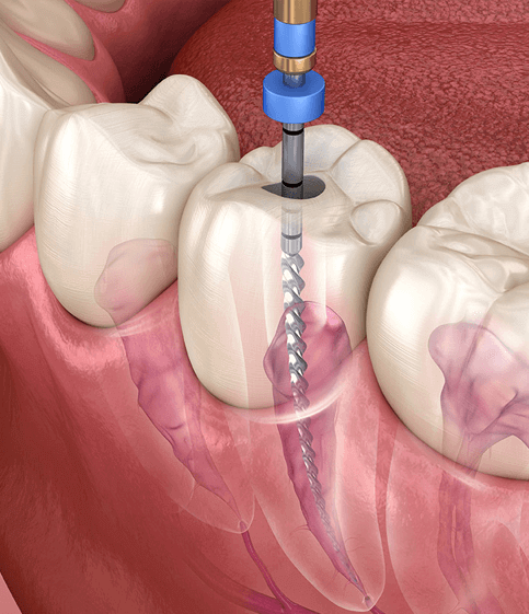 Root Canal Treatment
